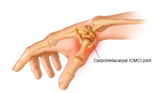 Carpometacarpal Joint Location