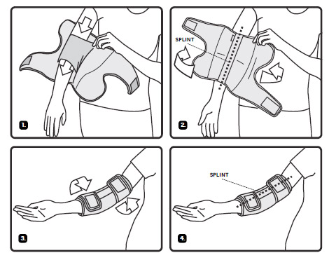 Fitting Guide for the Cubital Tunnel Syndrome Elbow Splint Fitting Guide for the Cubital Tunnel Syndrome Elbow Splint