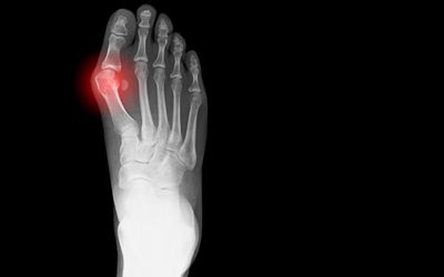 bunion pain image Bunion Pain Image